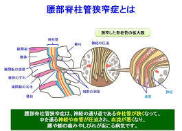 脊柱管狭窄症.jpg